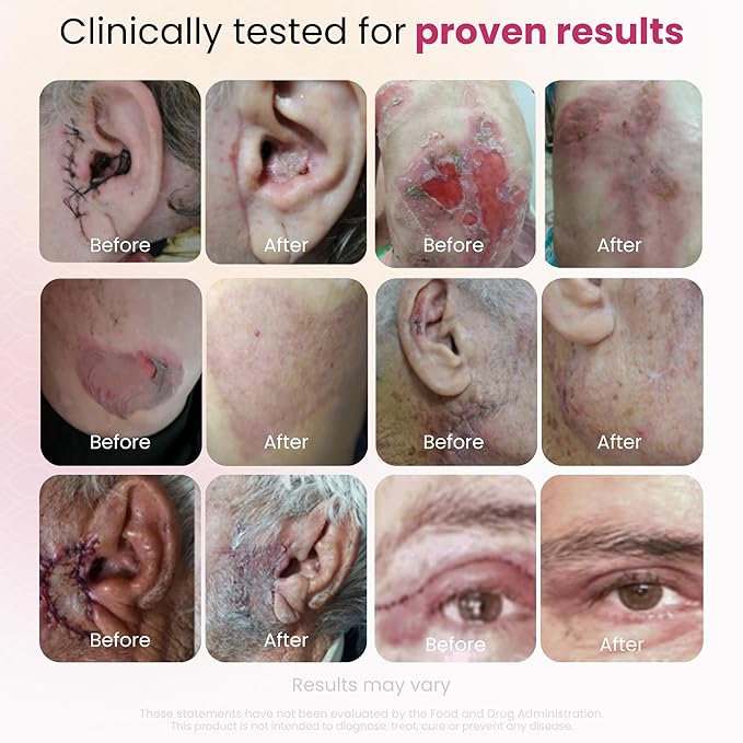 GlocalCare CICA Clinically Proven Wound Healing Supplement - Aids in Scar & - Image 4